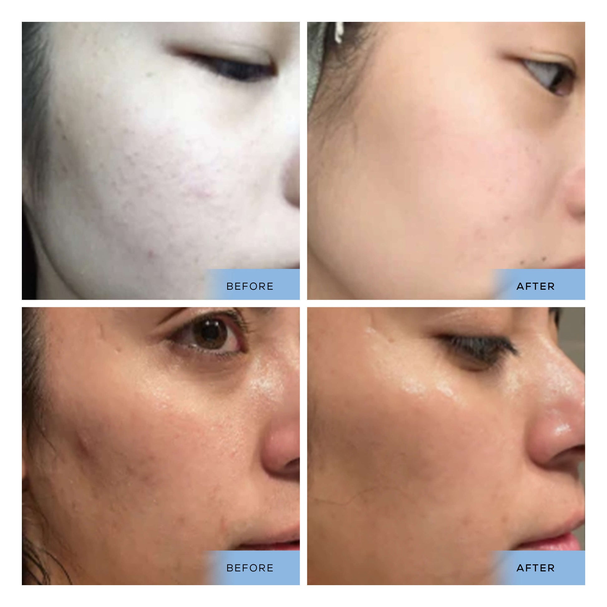 Before and after images demonstrating the skin improvement results from using Cosmedica Skincare Hyaluronic Acid + Vitamin B5 Serum.